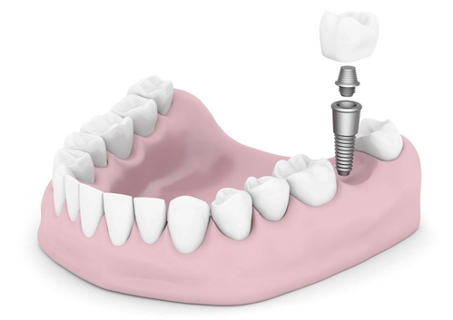 Dental implants isolated on white background