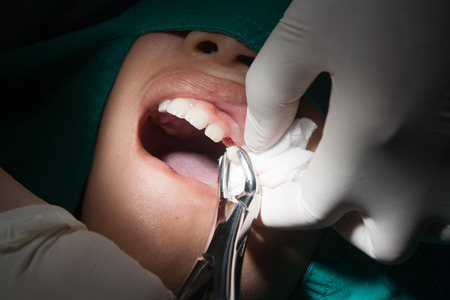 dentists are tooth extraction to patients